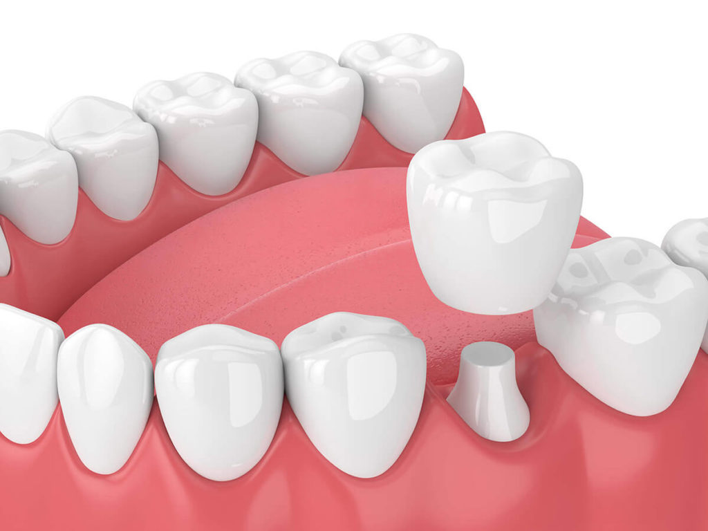 illustration of dental crown being place on tooth