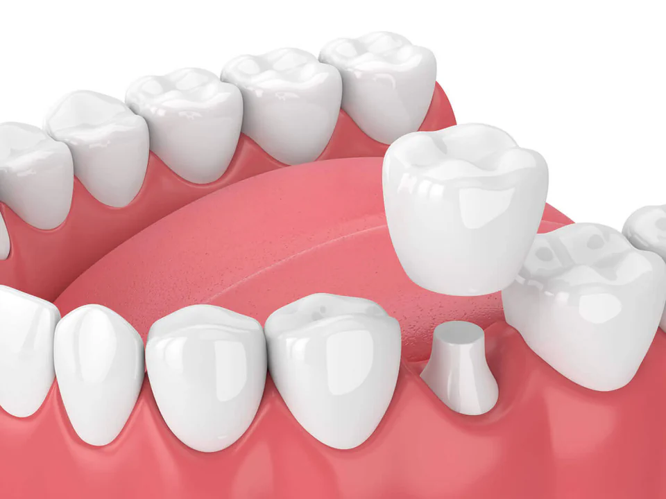 Dental crowns and bridges in the Kansas City area at Kansas City Smiles & Co.