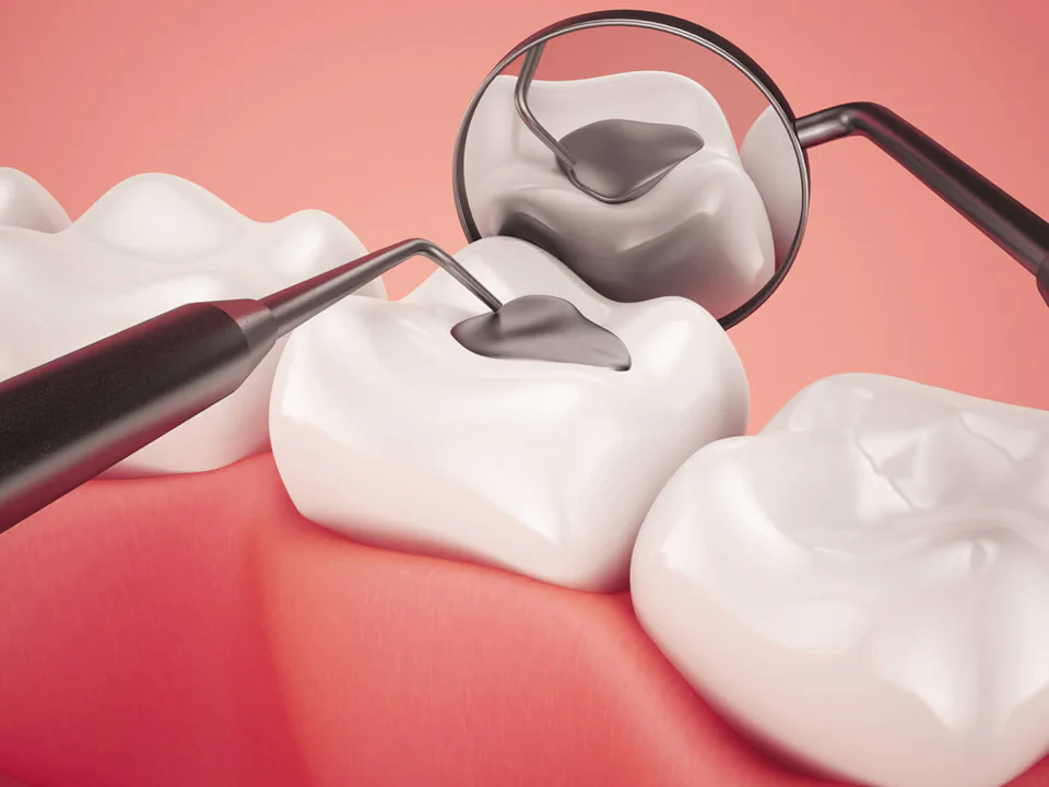 Cavity fillings and dental sealants in the Kansas City area at Kansas City Smiles & Co.