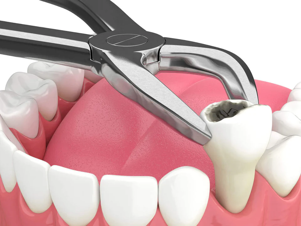 Tooth extractions in the Kansas City area at Kansas City Smiles & Co.