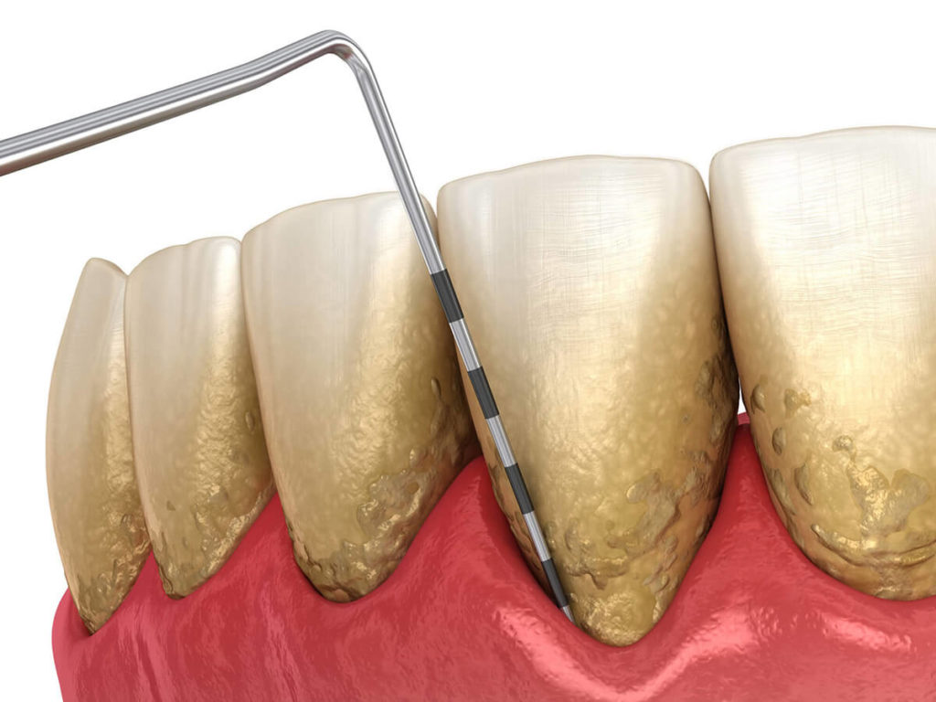 illustration of bottom teeth with periodontal disease