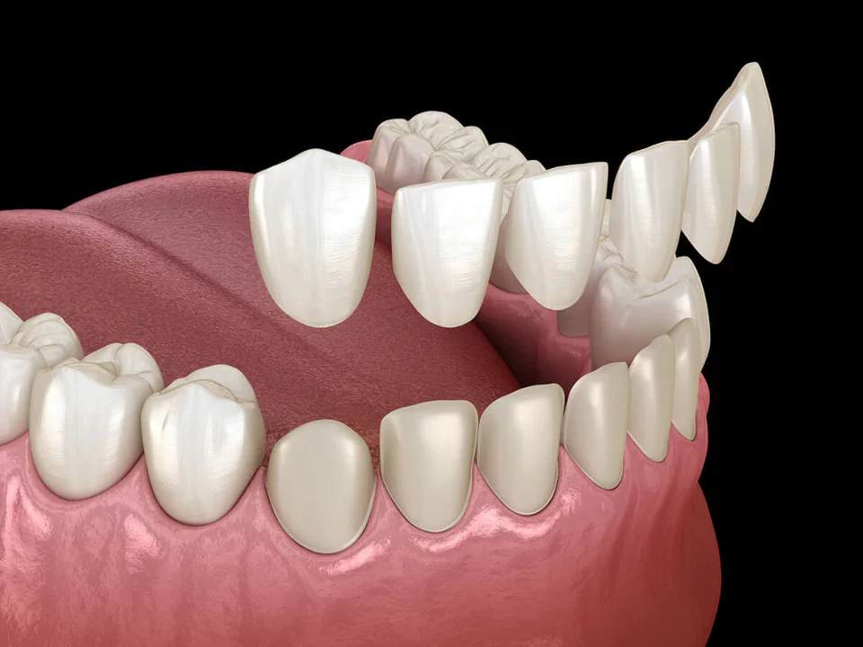 Dental veneers in the Kansas City area at Kansas City Smiles & Co.