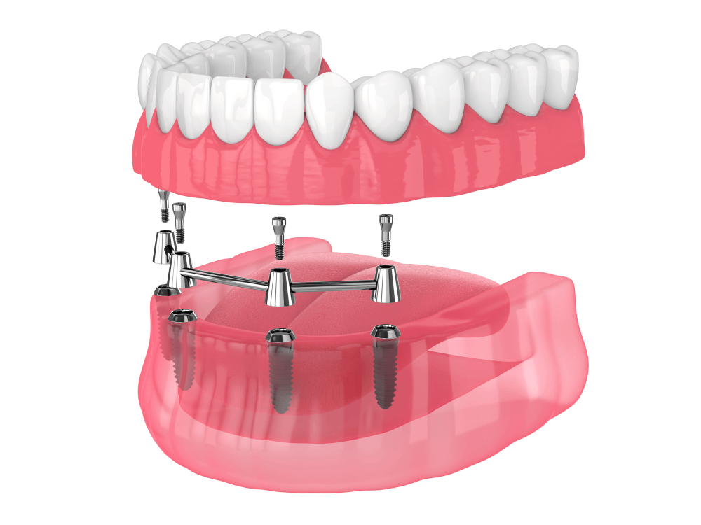 Graphic showing all-on-4 dental implants being placed in the jaw.