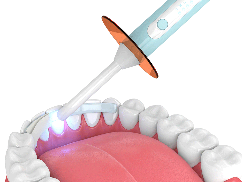 Graphic of dental bonding procedure.