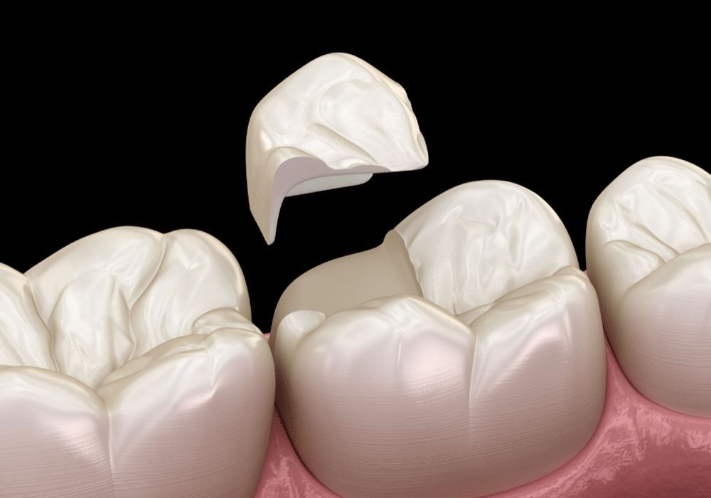 dental inlay illustration