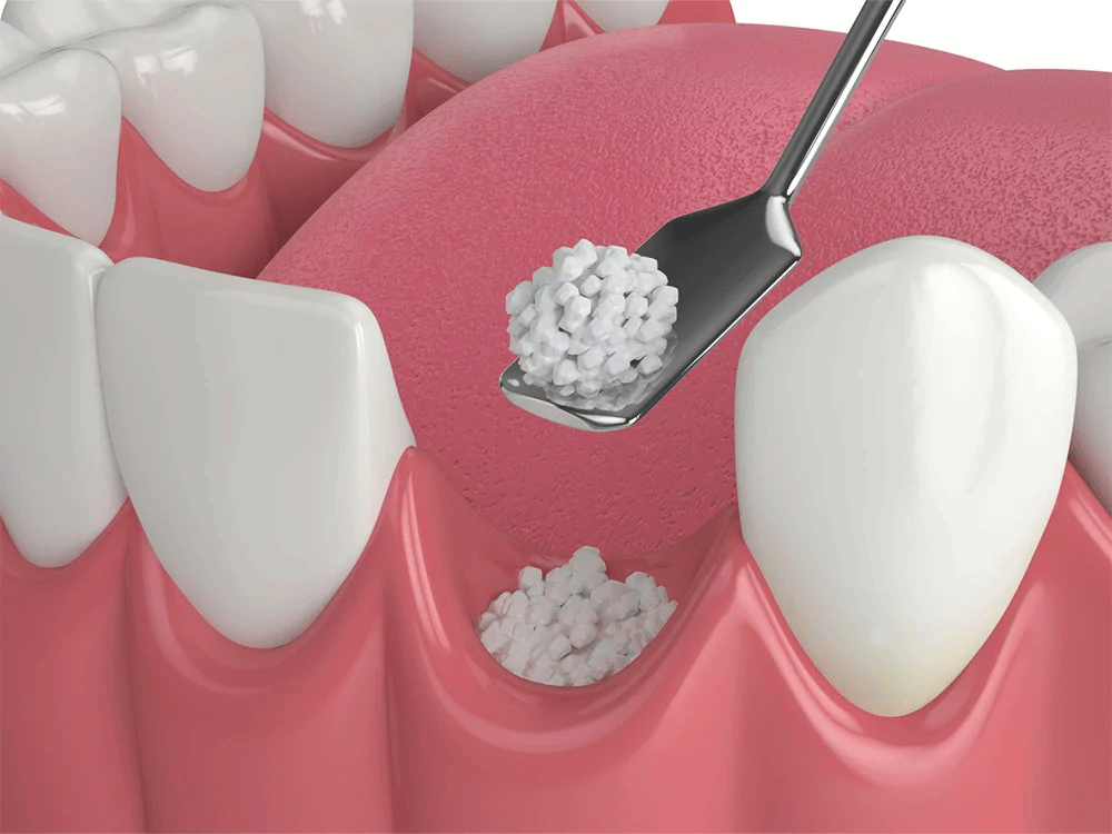 Graphic showing a dental bone grafting procedure.
