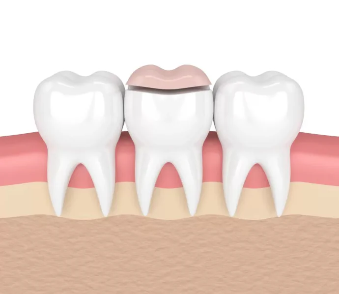 Dental inlays and dental onlays in the Kansas City area at Kansas City Smiles & Co.
