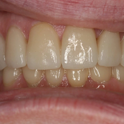 After photo of a patient's teeth