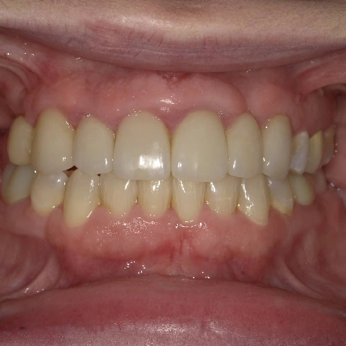 After photo of a patient's teeth