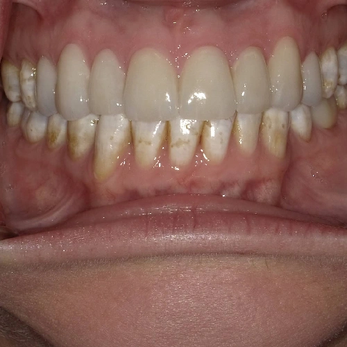 After photo of a patient's teeth