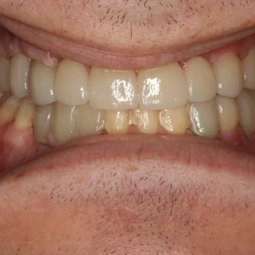 After photo of a patient's teeth