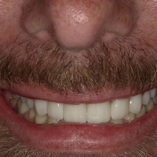 After photo of a patient's teeth