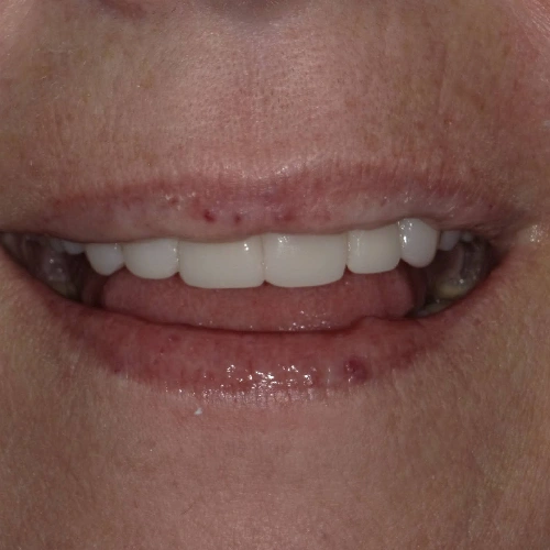 After photo of a patient's teeth