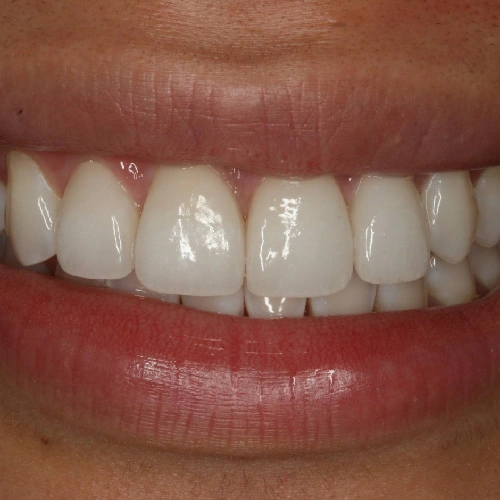 After photo of a patient's teeth