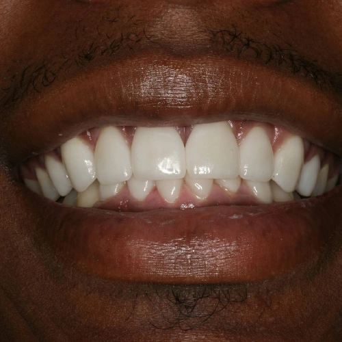 After photo of a patient's teeth