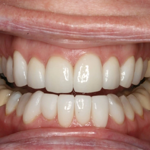 After photo of a patient's teeth