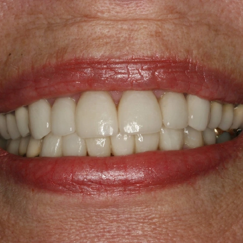 After photo of a patient's teeth