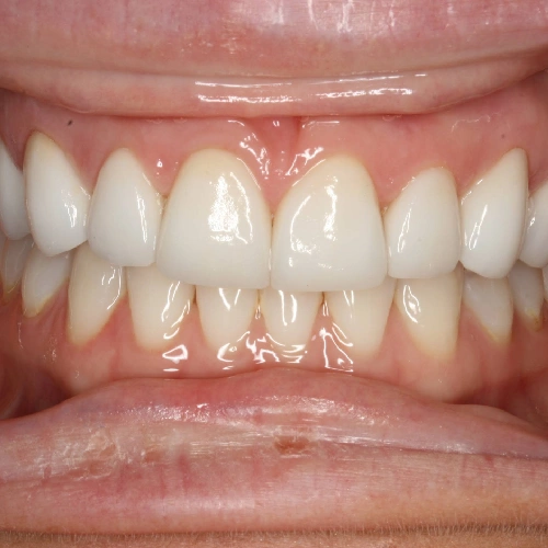 After photo of a patient's teeth