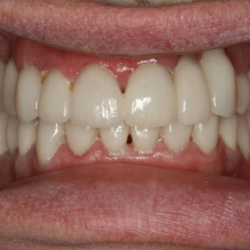 After photo of a patient's teeth