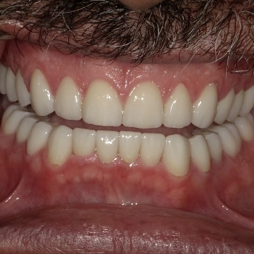 After photo of a patient's teeth