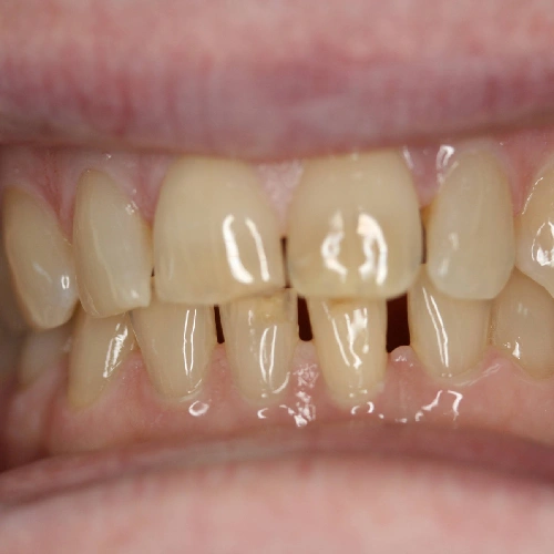 Before photo of teeth