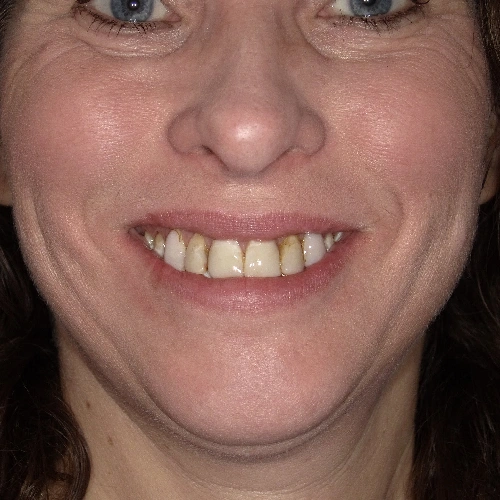 Before photo of teeth