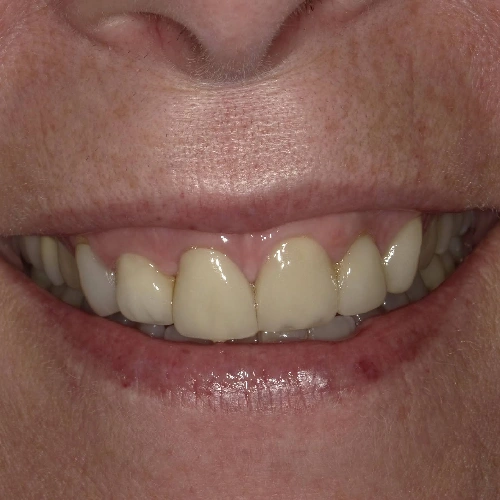 Before photo of teeth