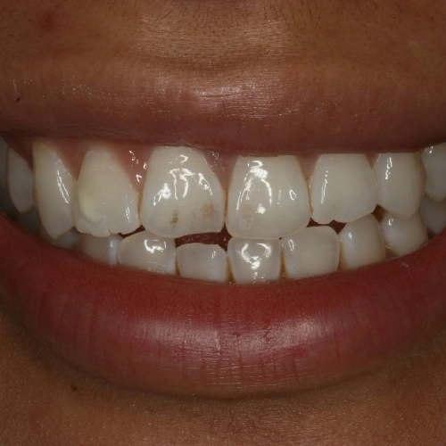 Before photo of teeth