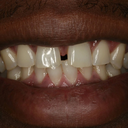 Before photo of teeth