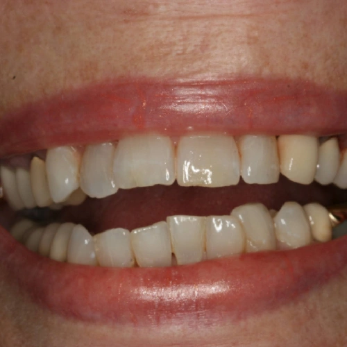 Before photo of teeth