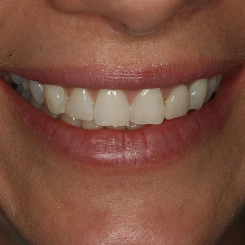 Before photo of teeth